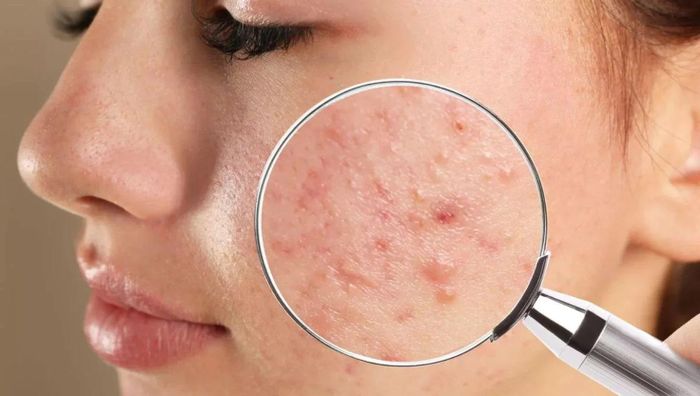 Da dầu dễ tích tụ bã nhờn và bụi bẩn hơn các loại da khác