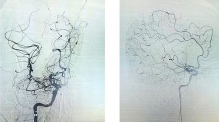 Hình ảnh cho thấy động mạch cảnh trong bên phải đã được tái thông hoàn toàn. Ảnh: BVCC