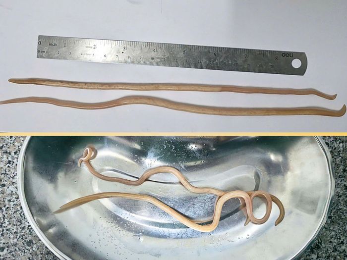  Bệnh nhi 12 tuổi vừa được nội soi gắp thành công hai con giun dài hơn 30 cm. 