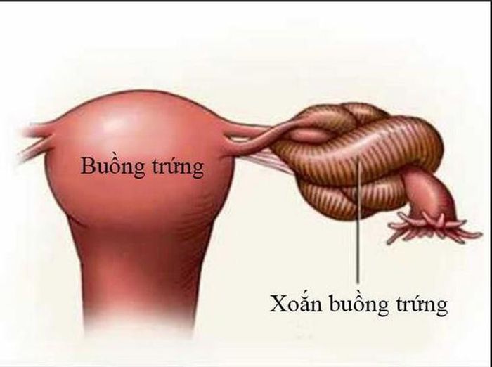 Xoắn buồng trứng có thể xảy ra ở mọi lứa tuổi, từ trẻ em, thanh thiếu niên đến phụ nữ trưởng thành. ảnh: KH