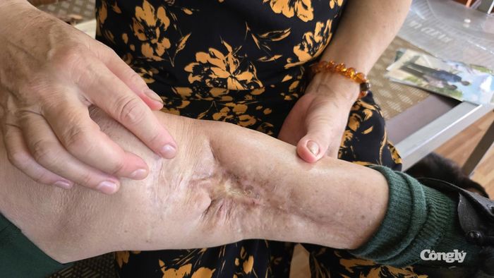 Vết thương chiến tranh vẫn còn hằn rõ trên cơ thể cựu chiến binh Lê Long Triệu sau hơn nửa thế kỷ.(Ảnh: TV)