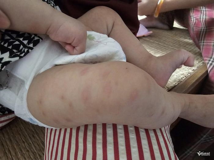 Mới 3 tháng tuổi, cơ thể đứa trẻ đầy những vết côn trùng cắn. Ảnh: Hải Sâm