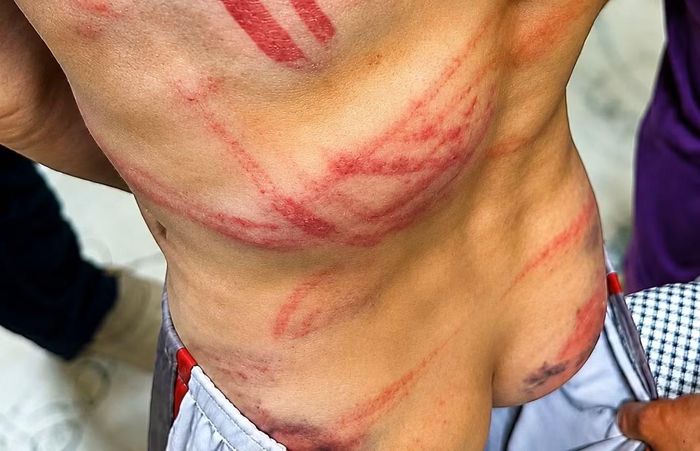 Cháu B bị nhiều vết thương trên cơ thể do bố đẻ dùng ống nhựa đánh.