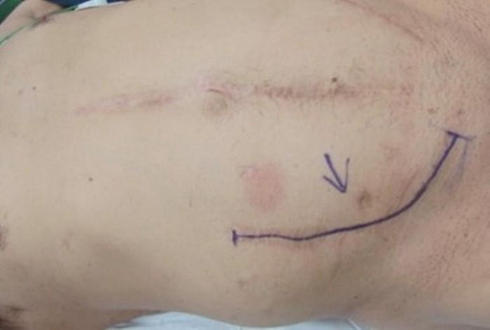 Ba vết sẹo cũ trên bụng bệnh nhân. Ảnh: BVCC.