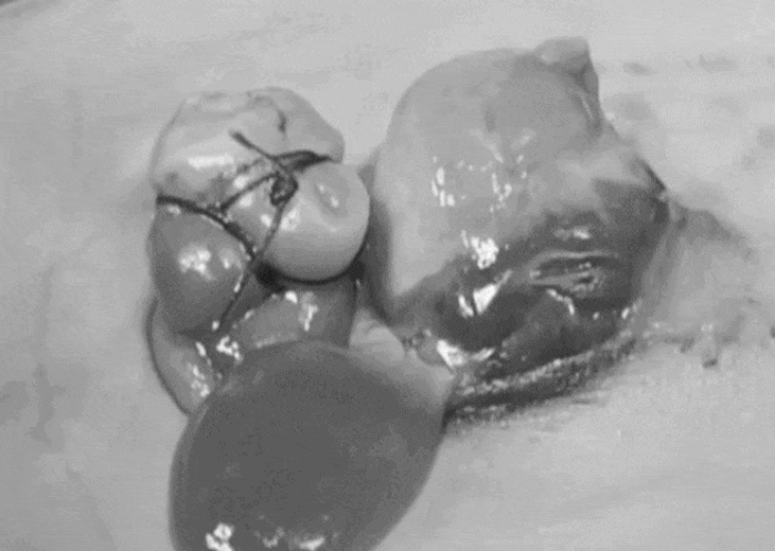 Mắc dị tật bẩm sinh hiếm khiến một phần tim thoát vị ra ngoài cơ thể, bé sơ sinh 4 kg được các bác sĩ Bệnh viện Nhi Đồng 1 phẫu thuật thành công. Ảnh: BVCC.