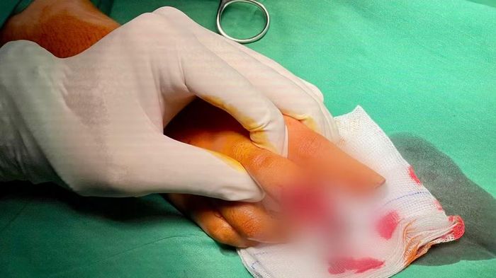 Trường hợp khác bị đứt đầu hai ngón tay do tai nạn lao động.