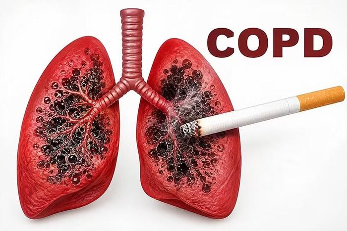 Nguyên nhân hàng đầu dẫn đến COPD vẫn là hút thuốc lá. Ảnh minh họa internet
