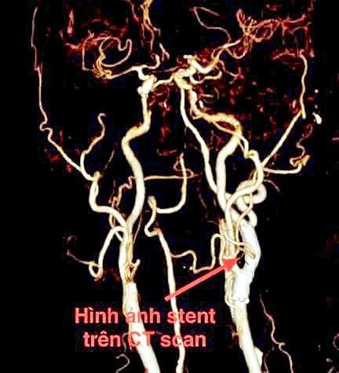 Kíp can thiệp của Trung tâm Cấp cứu và Đột quỵ, Bệnh viện Đa khoa số 2 Lào Cai đặt stent động mạch cảnh thành công, cứu sống bệnh nhân bị đột quỵ. Ảnh: Bệnh viện Đa khoa số 2 Lào Cai cung cấp