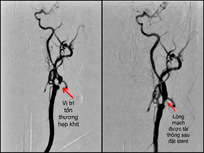 Hình ảnh vị trí mạch cảnh bị tắc nghẽn và lòng mạch được tái thông sau khi đặt stent của bệnh nhân. Ảnh: Bệnh viện đa khoa số 2 Lào Cai cung cấp