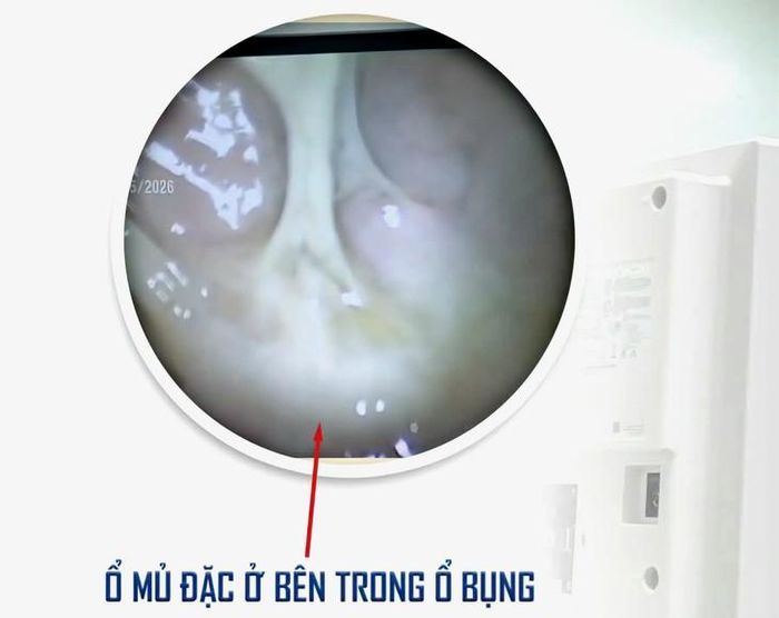 Hình ảnh nội soi ổ bụng cho thấy ổ mủ đặc trong ổ bụng do áp xe ruột thừa vỡ, được ê-kíp bác sĩ xử trí cấp cứu bằng phẫu thuật nội soi. ẢNH: BV.