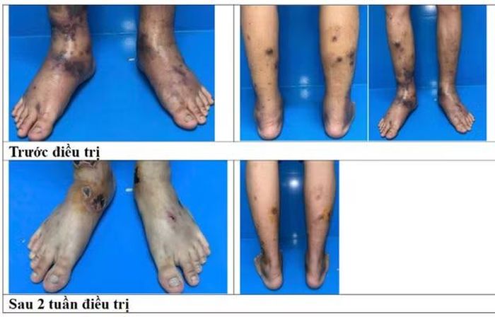 Bệnh nhân trước khi điều trị và kết quả sau 2 tuần điều trị. (Ảnh: PV/Vietnam+)