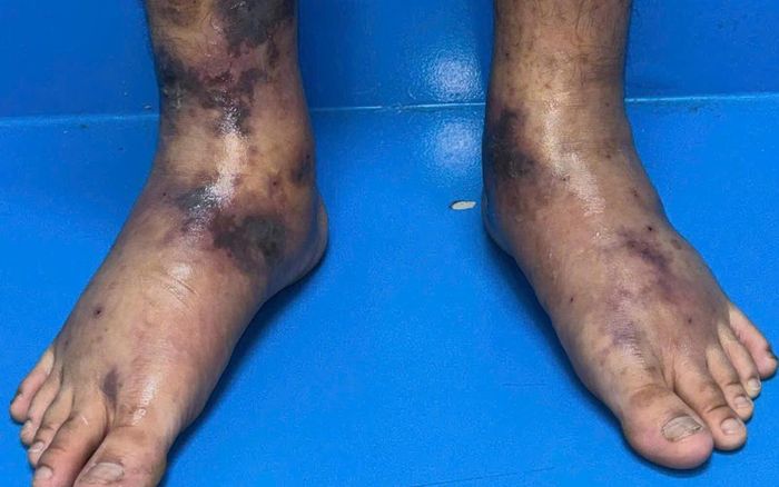 Chân bệnh nhân mắc u hạt tăng bạch cầu đa nhân ái toan kèm viêm đa mạch.