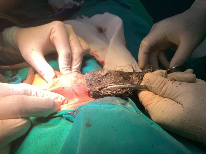 Khối dị vật gồm tóc và sợi vải dài gần 20cm được lấy ra từ dạ dày bé trai. Ảnh: BVCC