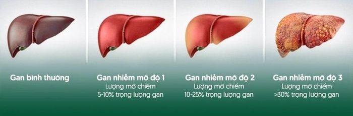 Gan bình thường và ba giai đoạn gan nhiễm mỡ. (Ảnh: Công ty Cổ phần Dược phẩm Eco)
