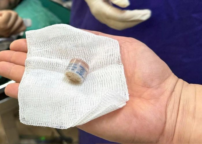 Dị vật là viên hộp chống ẩm hình trụ có đường kính khoảng gần 2cm trong người bệnh. Ảnh: BVCC