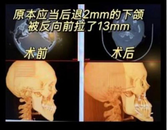 Ảnh chụp X-quang cho thấy xương hàm dưới của bệnh nhân bị đẩy ra phía trước đáng kể sau ca phẫu thuật, trái ngược với mục tiêu điều chỉnh ban đầu. Ảnh: Mạng xã hội