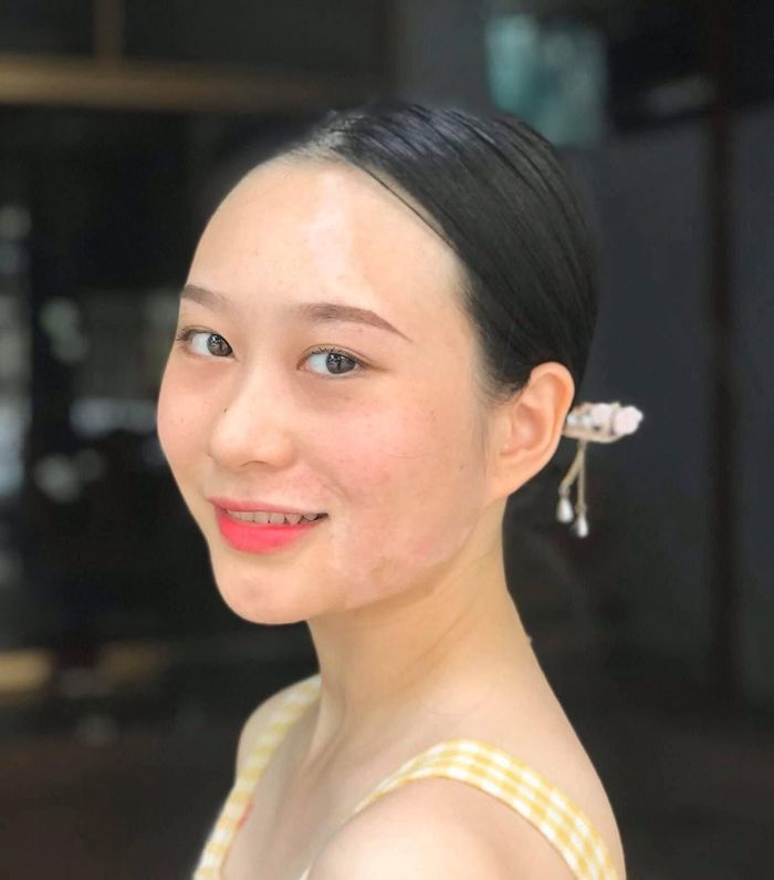Từng không dám buộc tóc vì những mảng trắng trên khuôn mặt, Nguyễn Hồng Hạnh nay tự tin để mặt mộc sau ca ghép tế bào sắc tố. Ảnh: NVCC.