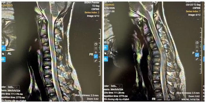 MRI tư thế trung gian và MRI tư thế gập cổ - Ảnh BVCC
