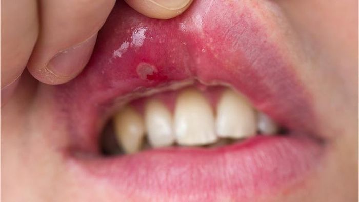 Bệnh nhân bị Lupus xảy ra các vấn đề liên quan đến khoang miệng thường xuyên. Ảnh B.S