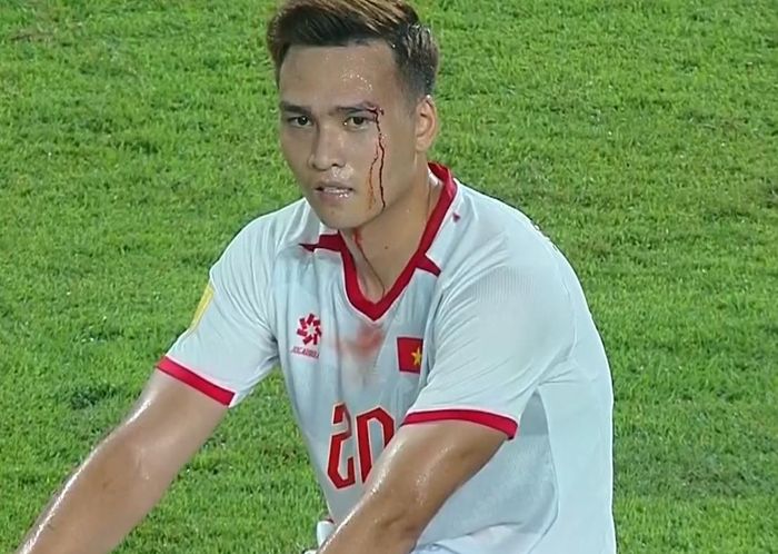 Bùi Hoàng Việt Anh đổ máu sau pha va chạm với tiền đạo Indonesia. Ảnh: FPT
