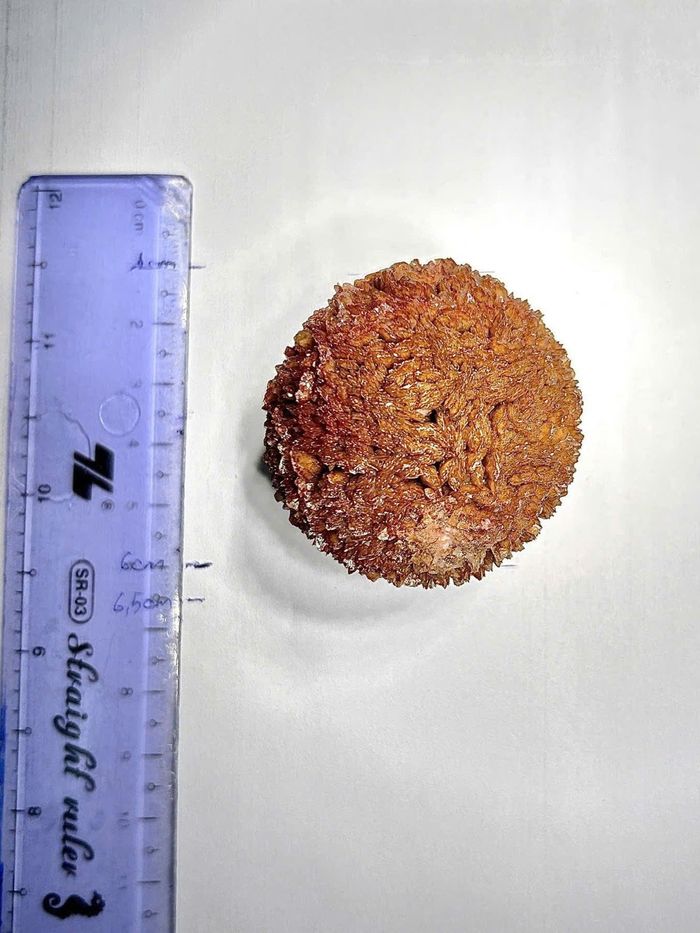  Viên sỏi dài trên 5cm, kích thước đặc biệt lớn. Ảnh: Bệnh viện cung cấp 