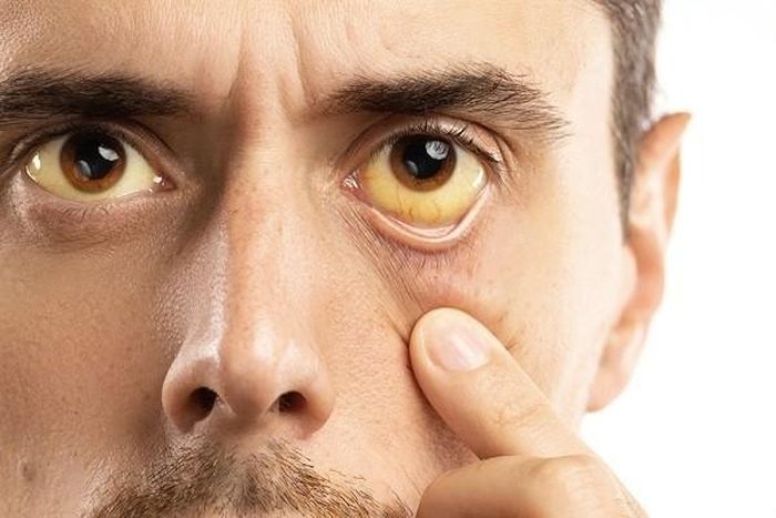 Vàng da, vàng mắt là triệu chứng cảnh báo bệnh lý về gan. Ảnh minh họa