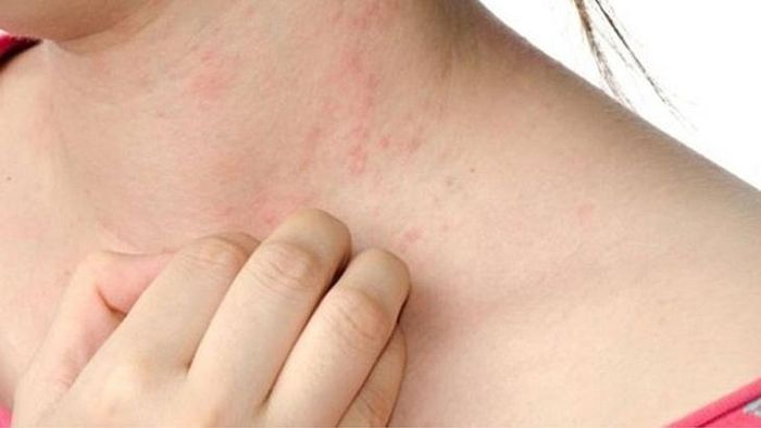 Ngứa và nổi mề đay có thể là biểu hiện ngoài da của nhiều bệnh lý khác nhau, trong đó có bệnh gan. Ảnh: MH