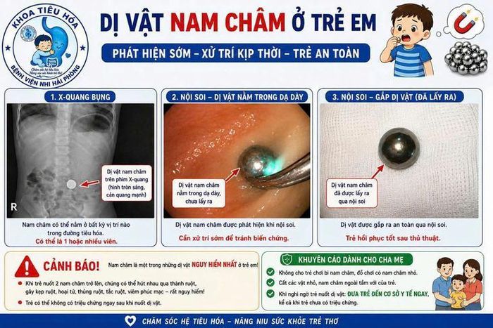 Bệnh viện Nhi Hải Phòng nội soi gắp dị vật thành công cho bệnh nhi 38 tháng tuổi nuốt phải viên bi nam châm - Ảnh: Bệnh viện Nhi Hải Phòng
