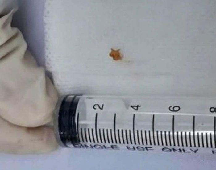 Dị vật là một mẩu xương lươn nằm trong phế quản bệnh nhi. (Ảnh: BVCC)