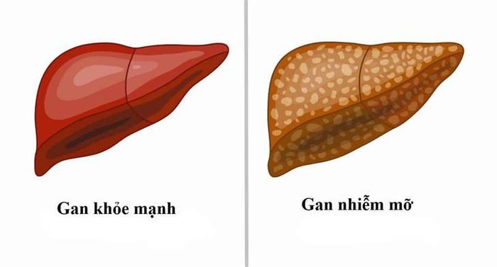 Gan nhiễm mỡ đang trở thành một trong những bệnh lý gan phổ biến nhất hiện nay. Nguồn AI