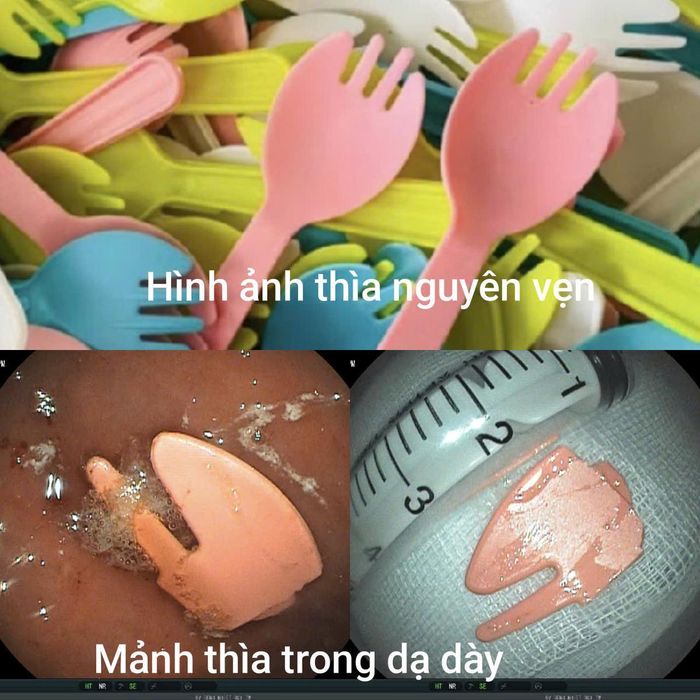 Dị vật được lấy ra trong dạ dày bệnh nhi.