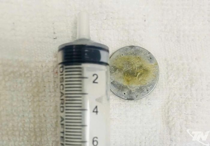 Viên pin điện tử dạng cúc áo có đường kính khoảng 3cm vừa được các bác sĩ Bệnh viện Đa khoa Bắc Kạn gắp thành công ra khỏi cơ thể trẻ.