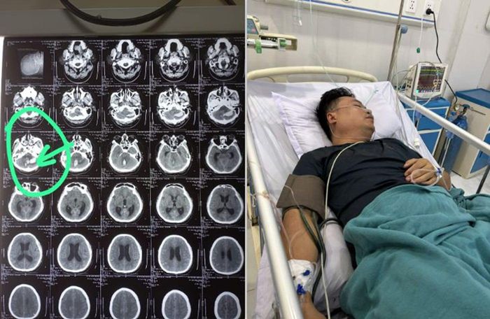 Anh Phương bất ngờ bị xuất huyết não (Ảnh: BVCC)