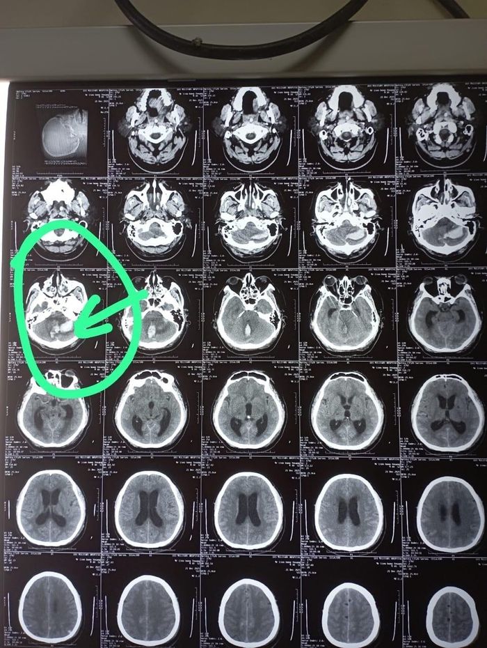  Phim chụp CT sọ não cho thấy một ổ chảy máu lớn ở tiểu não, vùng nằm sát thân não. Ảnh: BVCC. 