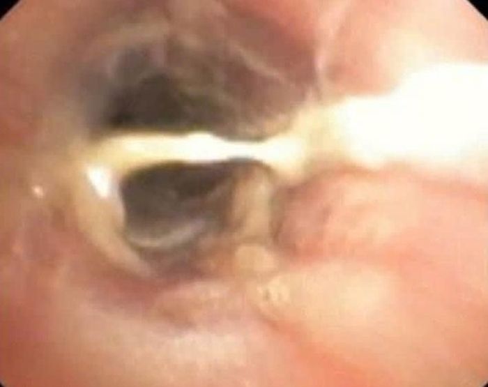 Dị vật trong phế quản bệnh nhi. Ảnh: BVCC