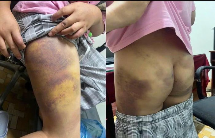  Những vết bầm tím trên người bé sáu sau khi bị người tình của mẹ đánh đập. Ảnh: L.V.T 