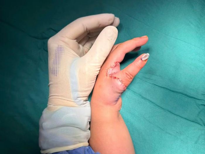 Ngón trỏ được tạo hình phù hợp với ngón cái - Ảnh BVCC