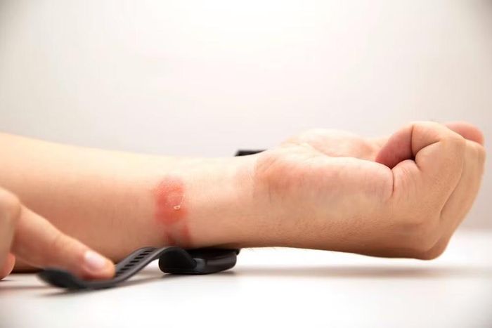 Mẩn đỏ dưới dây đeo đồng hồ thể thao thường liên quan đến mồ hôi, ma sát và vi khuẩn hơn là do chất liệu silicone.