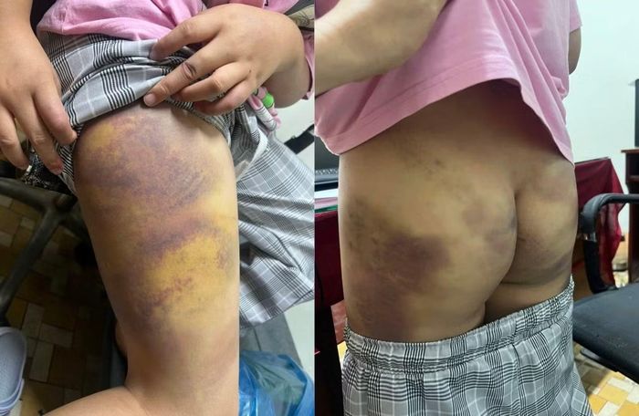 Một số dấu vết thương trên cơ thể cháu gái P.G.K.L.
