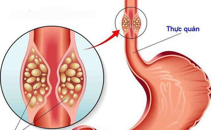 Nuốt khó, nuốt nghẹn là triệu chứng đặc trưng và thường gặp nhất. Ảnh BSCC