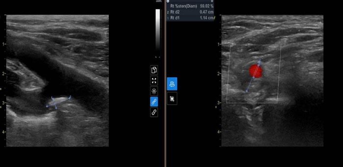 Hình ảnh siêu âm Doppler phát hiện tổn thương xơ vữa động mạch cảnh của người bệnh.