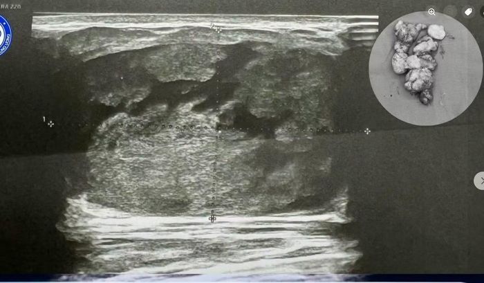 Hình ảnh siêu âm và khối u lấy ra khỏi ngực bệnh nhân - Ảnh BVCC