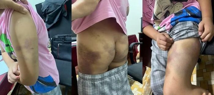  Thương tích trên cơ thể bé gái sau những trận đòn của người tình của mẹ (ảnh: CACC) 