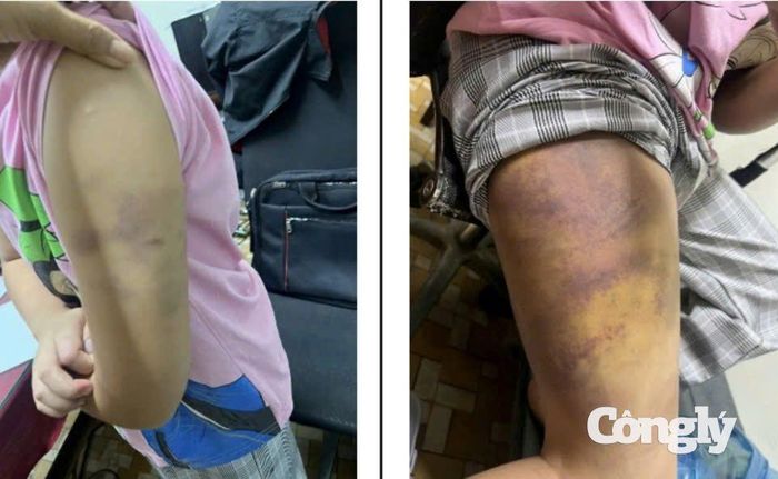 Cháu P.G.K.L bị Dương Đại Long dùng nẹp gỗ đánh đập, bạo hành liên tục trong nhiều ngày. (Ảnh: Văn Thủy)