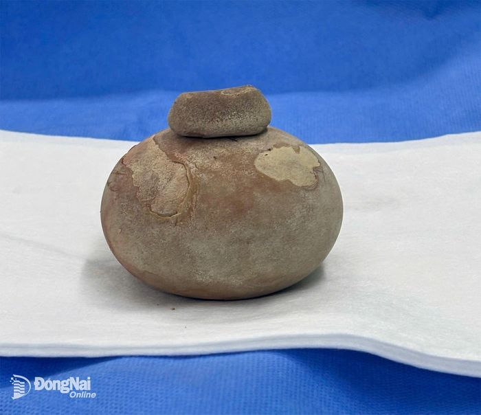 2 viên sỏi, trong đó có 1 viên kích thước rất lớn được lấy ra khỏi cơ thể bệnh nhân. Ảnh: BSCC
