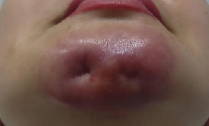 Vùng cằm bị biến dạng sau khi tiêm Silicone.