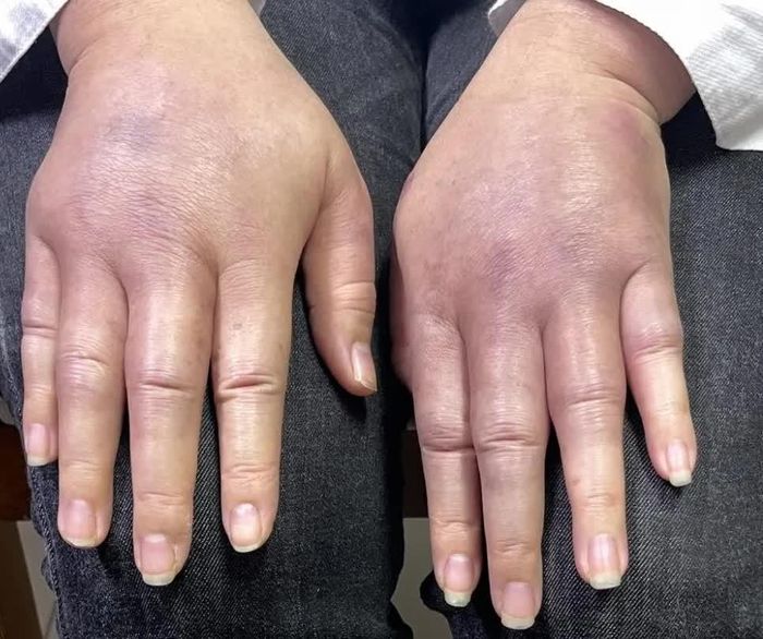 Hai tay bị sưng tím sau khi tiêm chất được gọi là mỡ nhân tạo.