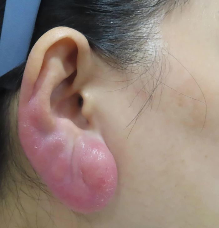 Chỉ một thời gian ngắn, chị đã thấy những vùng được tiêm bị chai cứng, xuất hiện dấu hiệu sưng đỏ, tím tái.