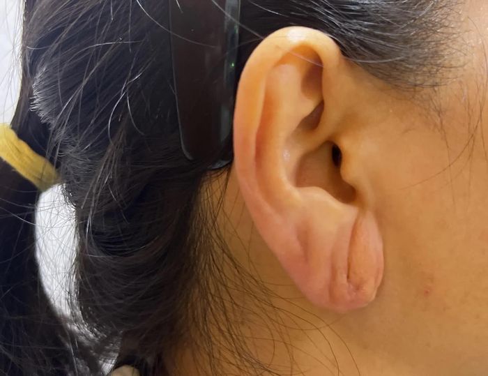 Phần tai bệnh nhân phục hồi sau khi điều trị.