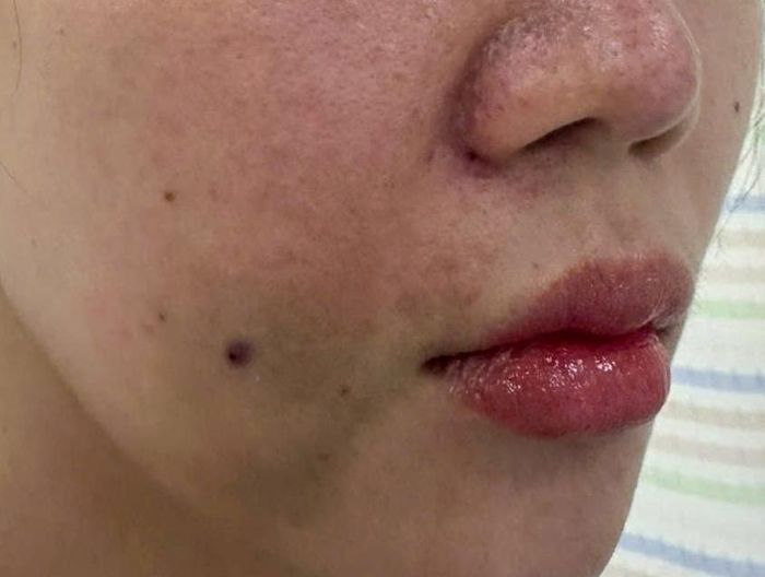 Dấu hiệu hoại tử da sau khi tiêm filler còn lan rộng gây tím tái cả vùng má. Ảnh BVCC.